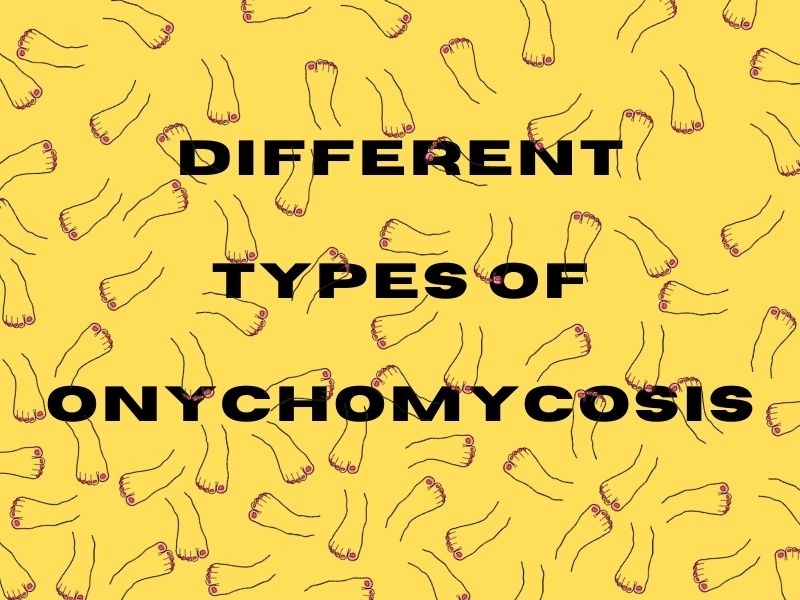 Different Types of Onychomycosis