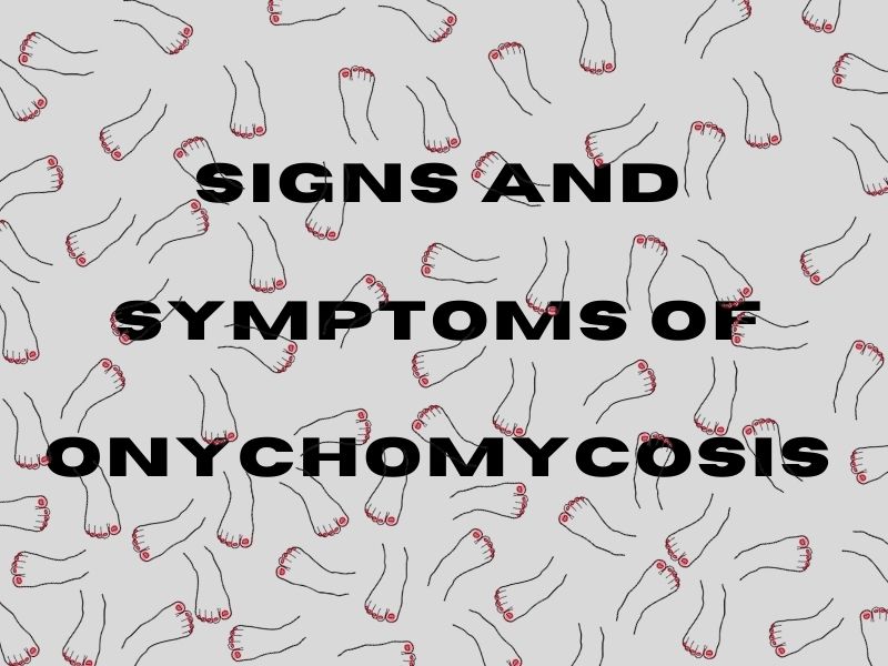 Signs and Symptoms of Onychomycosis