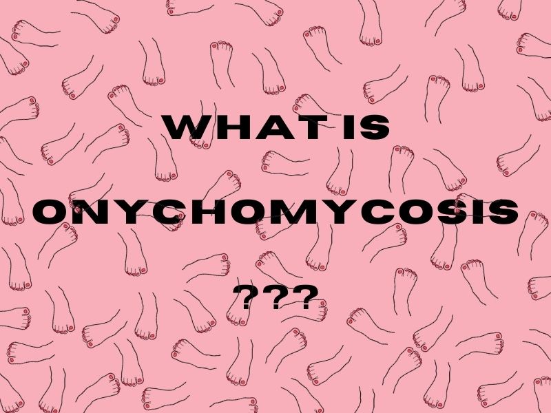 What is Onychomycosis?